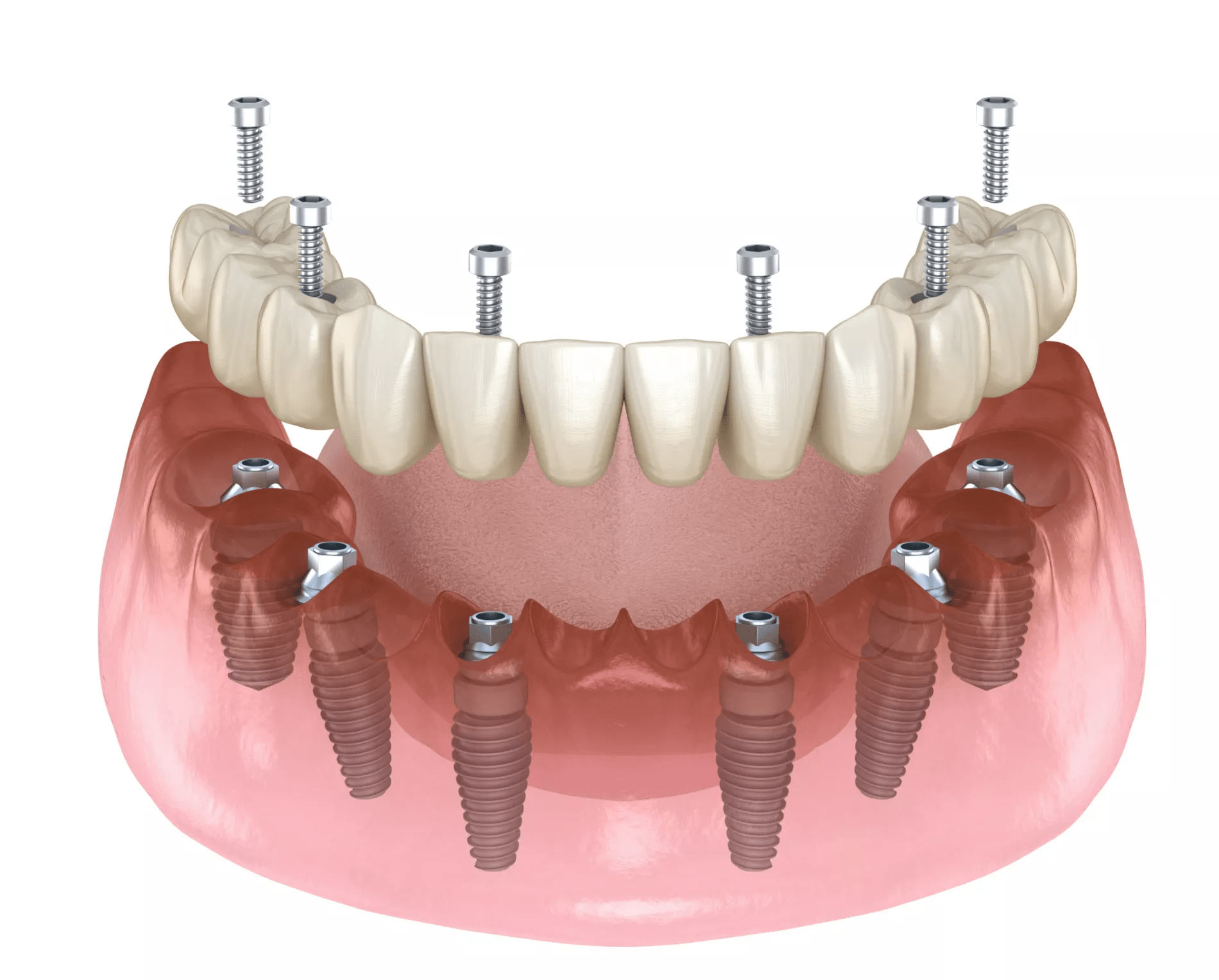 Costo Impianto Dentale Roma Quali Elementi Considerare Dentistart Srl